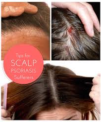 Beyond the differences in their causes, dandruff is described as the flaking skin of the scalp. Tips For Finding Effective Relief From The Symptoms Of Scalp Psoriasis Mumslounge