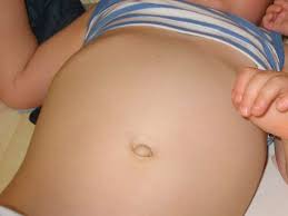 Ein narbenbruch wird in der regel immer operiert, da er sich nicht von selbst zurückbildet. Sohn Am Bauchnabel Operieren Lasse Gesundheit Sorgen Nabel