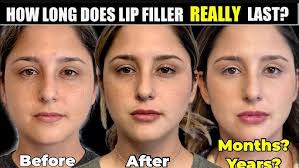 upper lip + columns LIP FILLER techniques- watch till the end for before  and after!