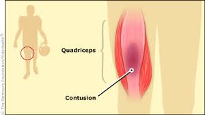 Image result for Contusion