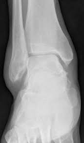 Os cuboideum hariç, tüm tarsal kemikler ve ilk 3 metatarsal kemik arasında bulunur. Medial Malleolus Ossicle Radiology Case Radiopaedia Org