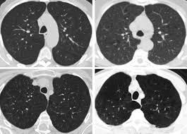 Image result for Emphysema