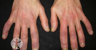 Image result for Connective Tissue Disorder