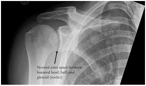 The shoulder series is fundamentally composed of two orthogonal views of the glenohumeral joint including the entire scapula. Shoulder Arthritis Michael Fu Md Hss Shoulder Surgery