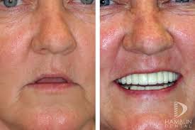 Dental Implants Utah