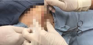 Pimple popper erklärt, was gegen akne hilft. Dr Pimple Popper In Aktion Horror Video Monstrose Ekel Beule Wird Ausgequetscht News De