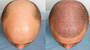 6 Weeks After Hair Transplant | Reniu ...