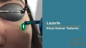 Instagram Da Dr Gokhan Gokler Dermatologist Kilcal Damar Tedavisi Yaklasik 5 10 Dakika Suruyor Islem Sonrasinda Y Instagram Instagram Profile Dermatologist