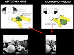 Image result for Visual Field Deficit