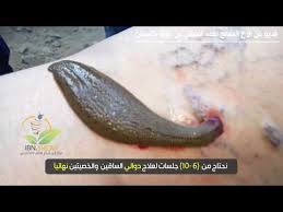 👈دوالي الساقين من المشاكل المنتشرة بشده ، في حلقة اليوم من فِكر تاني نتحدث عن الأسباب والعلاج النهائي. Ø¹Ù„Ø§Ø¬ Ø§Ù„Ø¯ÙˆØ§Ù„ÙŠ Ø¨Ø§Ù„Ø¹Ù„Ù‚ Ø§Ù„Ø·Ø¨ÙŠ Ù…Ø±ÙƒØ² Ø§Ø¨Ù† Ø´ÙŠØ§Ø¹ Ø§Ù„Ù†Ù…ÙˆØ°Ø¬ÙŠ Ù„Ù„Ø·Ø¨ Ø§Ù„ØªÙƒÙ…ÙŠÙ„ÙŠ