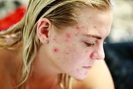 More severe cases may take longer but typically do respond with these same treatments. How To Tell If You Ve Got Fungal Acne And Treat It Fine Feather Heads