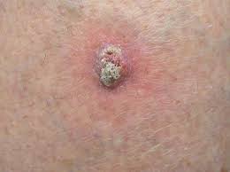 Diagnosis requires microscopic evaluation as the clinical appearance is nonspecific and can mimic a variety of benign and malignant skin lesions. Symptoms Of Merkel Cell Carcinoma