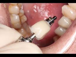 Zirconia crowns are the most important types of crowns in the recent times. Full Contour Zirconia Implant Crown Insert Youtube