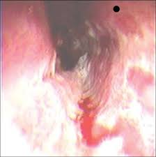 Must rule out hsv infection as cause of esophageal ulcers, particularly from immunocompromised patients. Endoscopic View Of Necrotic Confluent Esophageal Ulcers Download Scientific Diagram
