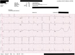 It does not travel along any cardiac groove but simply present over the surface of the ventricle. Acute First Diagonal Artery Occlusion A Characteristic Pattern Of St Elevation In Noncontiguous Leads The American Journal Of Emergency Medicine