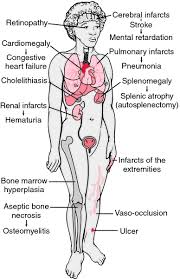 Pin On Sickle Cell Complications