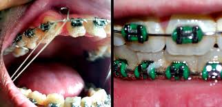 To get started, stand in front of a mirror. How Long Do You Have To Wear Rubber Bands For Braces Orthodontic Braces Care