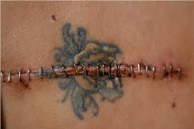 Covering up a mole or birthmark with a tattoo can make it more difficult to detect the development of skin cancer, like melanoma. Study Explores How Tattoos May Influence Medical Student S Understanding Of Melanoma Diagnosis Faculty Of Medicine