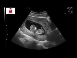 شكل الجنين الذكر في الاسبوع التاسع بالسونار