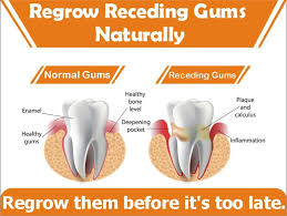 Then it becomes a more serious form of. Natural Ways To Reverse Receding Gums By Lori Baldwin Medium