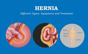 Image result for stomach hernia symptoms