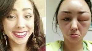 But as long as you follow experts' advice (i.e. Shocking Photos Show Woman S Ballooning Face After Allergic Reaction To Hair Dye Huffpost Uk Life