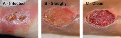 Microbiologists Want W.o.u.n.d.s. To Become Colonised With Bacteria! -  Microbiology Nuts & Bolts