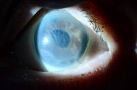 Cornea & External Eye Diseases | Conditions & Treatments | Utsw Medical  Center