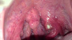 In severe cases, this infection can spread to the esophagus, in the throat causes in such a case, a white coating. White Spot On The Throat Youtube