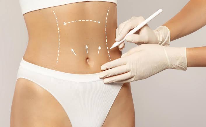 Liposuction And High-Definition Liposuction What's The Difference?
