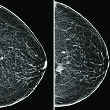 There are few risks associated with mammography. Pdf Breast Cancers Missed During Screening In A Tertiary Care Hospital Mammography Facility