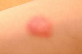 Maybe you would like to learn more about one of these? Pertolongan Pertama Pada Luka Memar Alodokter