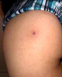 Check spelling or type a new query. Anyone Know How To Get Rid Of A Boil Scar It S Been About A Month It S Healed Now But This Ugly Scar Was Left On My Butt Dermatologyquestions