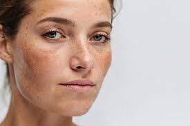 Image result for Freckles