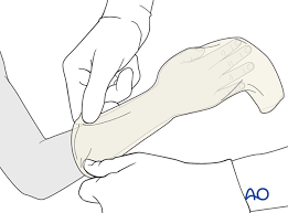 Image result for Short Arm Cast