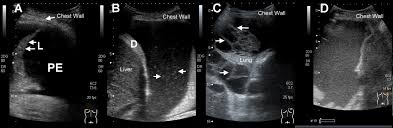 The pleura is a thin membrane that lines the surface of your lungs and the inside of your chest wall. Ultrasound Diagnosis Of Chest Diseaseses Intechopen