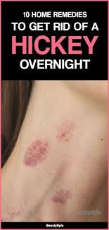 Top 10 Easy Ways To Get Rid Of A Hickey Overnight Hickeys Get Rid Of Hickies Rid