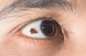 Image result for lesion sclera