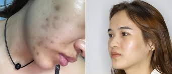 Chuyên gia Singapore gợi ý giải pháp trị nám lâu năm