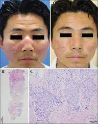 Lupus pernio is a serious skin condition that sarcoidosis may cause. John Libbey Eurotext European Journal Of Dermatology Sarcoidosis Mimicking Malar Rash A Case Of Lupus Pernio