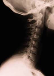 Bone cancer can affect any bone, but most cases develop in the long bones of the legs or upper arms. Nhs 111 Wales Health A Z Cancer Of The Oesophagus