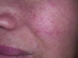 Rosacea Rosazea Symptome Ursachen Und Komplikationen