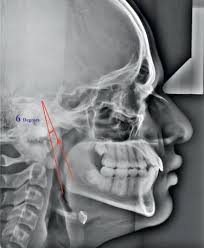Is The Mandible Still Growing After 29 Years? This Woman Mewing For A Year,  She Is 29 : R/Orthotropics