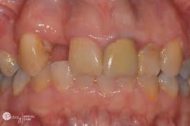 Oral cancer may be discovered when the dentist does a routine cleaning and examination. Oral Cancer As Told By A Top Dentist In Ryde Dentist Putney