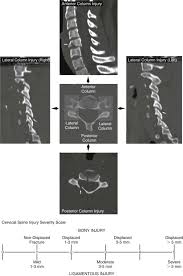 Image result for Subaxial Injury Classification Scale