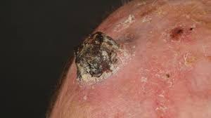 Image result for cornu cutaneum)