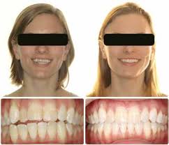 The Academy for Clear Aligner Therapy American Academy of Clear Aligners