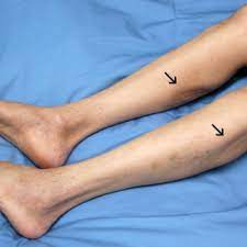 Muscle atrophy is caused due to several reasons. Pdf Dissociated Lower Limb Muscle Involvement In Amyotrophic Lateral Sclerosis