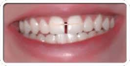 Maybe you would like to learn more about one of these? Teeth Gap Bands Close Gapped Teeth