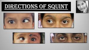 Image result for Eye Deviation